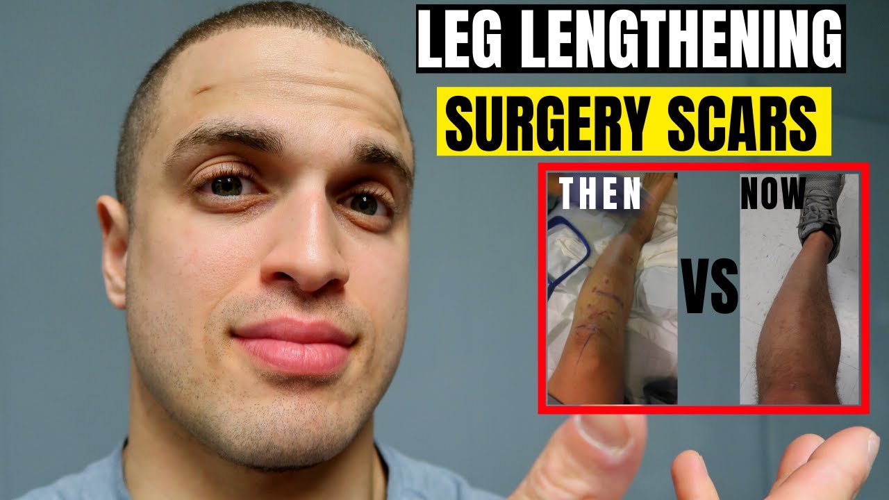 The scars of limb lengthening surgery - YouTube