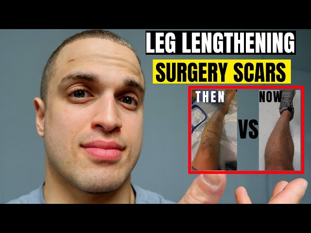 Scars After Leg Lengthening Surgery: Types and Solutions - Wanna Be Taller