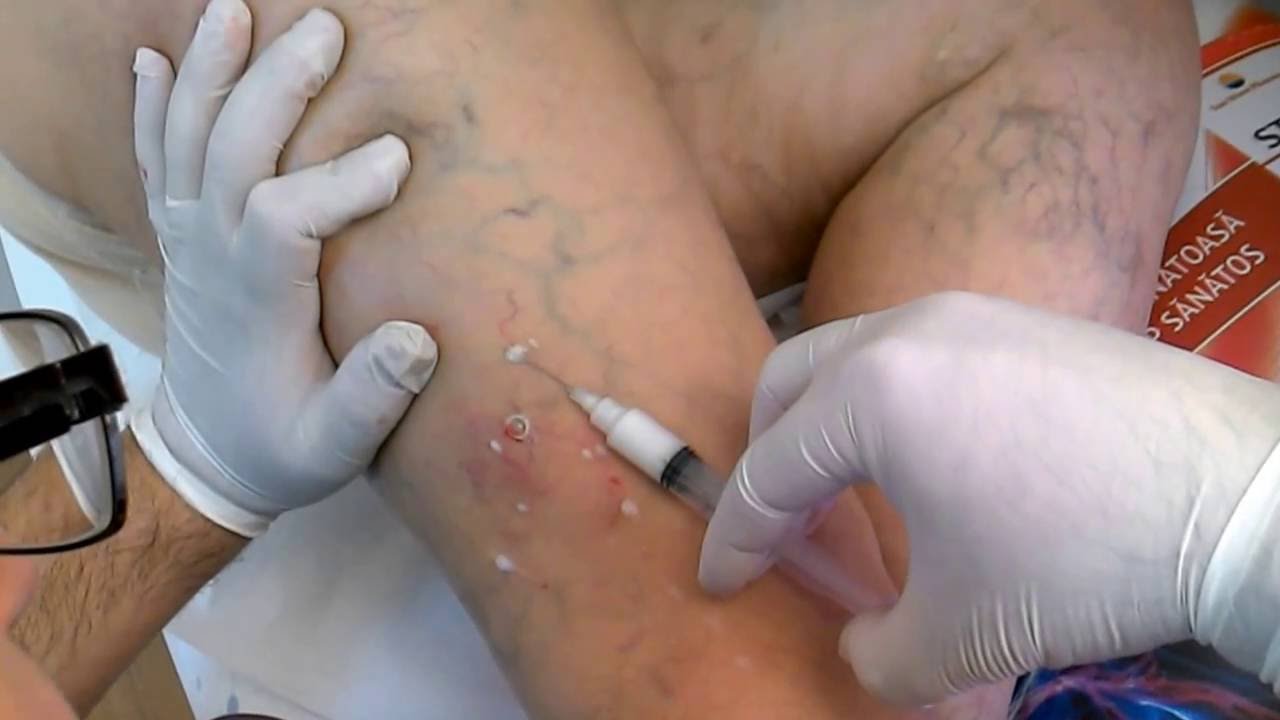 Bioptron tratează varicele - Varicoza i rosa