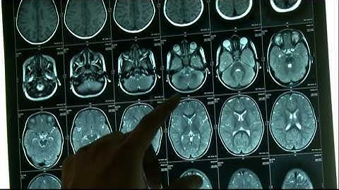 Radiology of Cochlear implant ( Video 1 ) - Dr. Satish Jain - www.skullbase360.in