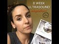 Possible miscarriage || 8 Week Ultrasound