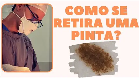 Tem como tirar pintas da pele?