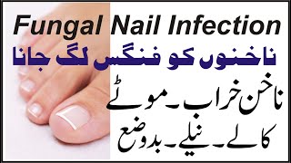 Fungal Nail Infections treatment | Nakhun ki fungus ka ilaj