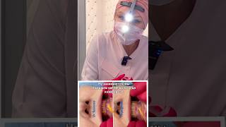 Овал лица, пародонт #doctor #botox #science #filler #education #beauty #skincare #factshorts #facts