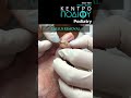 Toe Callus Removal|Αφαίρεση Επιδακτύλιου Κάλου|Ποδιατρική|Ποδολογία|Ποδίατρος|Podiatrist|Footcare