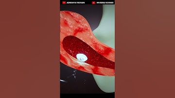 Early-stage ABORTION Procedure 3D Animation🔥🔥