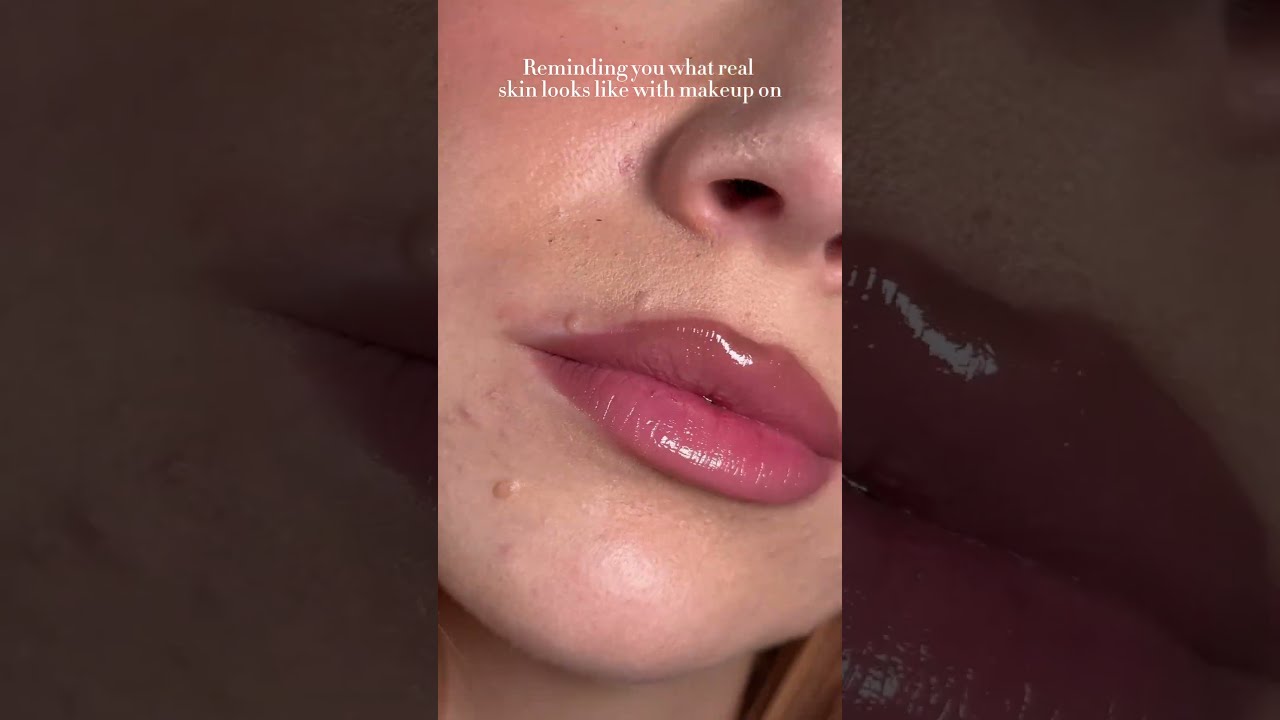 Reminder Of Real Skin Realskin Skintexture Acne Acnescars