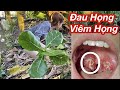 Cách Trị Đau Họng - Viêm Họng Tại Nhà Cực Kỳ Hay Không Bị Tái Phát