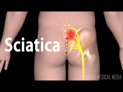 Sciatica:  signs and symptoms, causes, treatment, animation