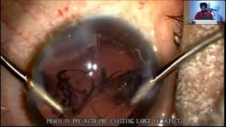 AIOCMTC4 2025  POS VT151   Dr Raminderjit Singh   Behind the Broken Curtain cataract surgery in an e