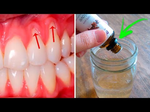 3 Easy Ways to Heal Receding Gums Naturally
