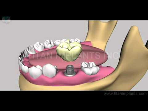 Titan Design Solid Abutment compatible with ITI Implant