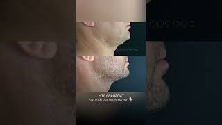 МУЖСКАЯ ПЛАСТИКА | КОРРЕКЦИЯ ГИНЕКОМАСТИИ
