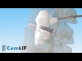 CemLIF Walkthrough