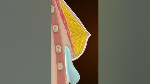 Đã bao giờ bạn thắc mắc quy trình đặt túi ngực diễn ra như thế nào chưa??  | Dr.KOKO