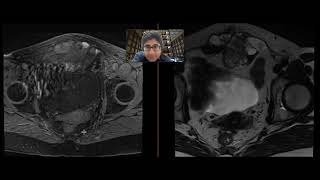 Clear cell carcinoma of abdominal wall