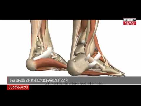 რა არის ბრტყელტერფიანობა