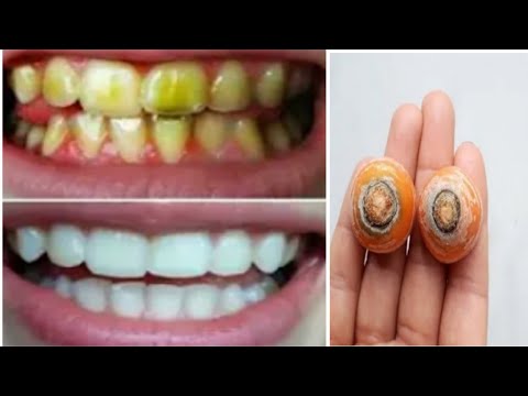 Easy-Teeth-Whitening-at-Home-i