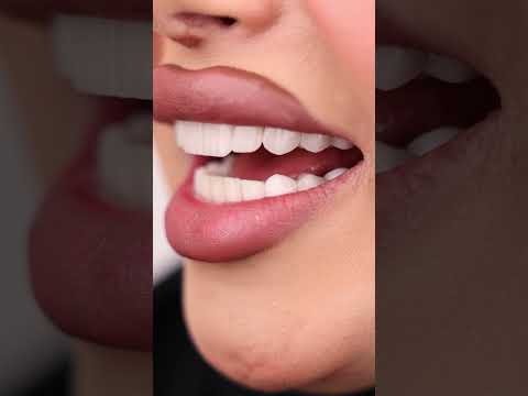لوحة فنية من حالات دكتور سامح مصطفي بمركز عناية الطبي هوليود سمايل