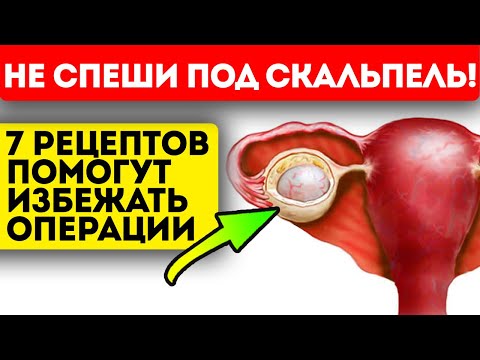 Хирургу лишь бы резать?! От этих рецептов киста яичника рассосётся сама