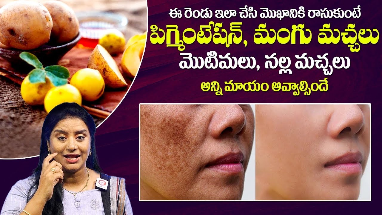 How To Get Rid Pigmentation On Face In Telugu How To Get Rid Dark how-to-get-rid-pigmentation-on-face-in-telugu-how-to-get-rid-dark