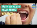 How to Floss with Braces? - 3 Flossing Tips