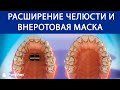 Типы ортодонтия — Расширение челюсти и внеротовая маска ©