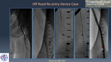 CTO Devices for SFA Occlusion - Nicolas Shammas, MD