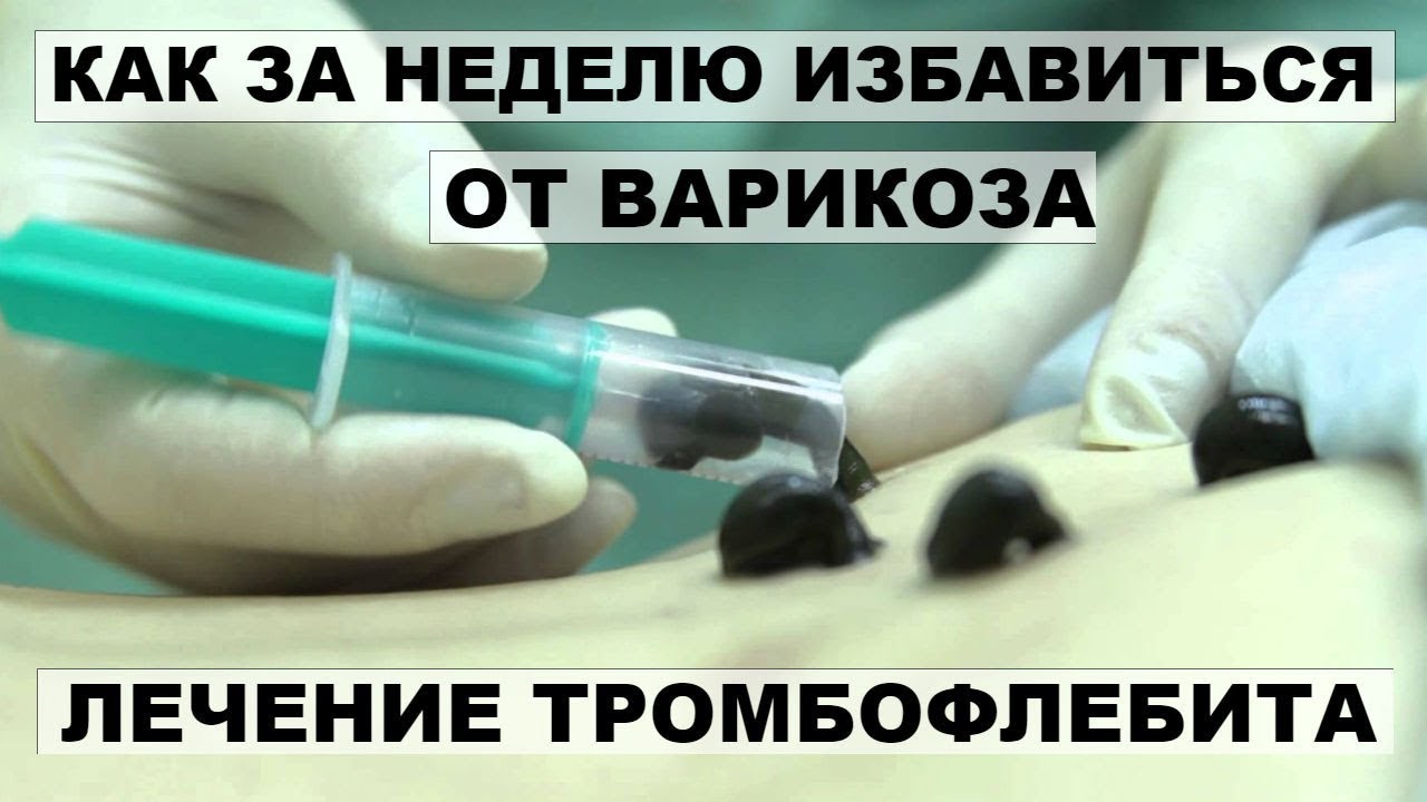 КАК ЗА НЕДЕЛЮ ИЗБАВИТЬСЯ ОТ ВАРИКОЗА. Лечение тромбофлебита.