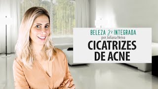 Cicatrizes de Acne | Juliana Neiva