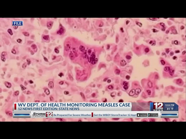 Department of Health: 128 West Virginians exposed to measles following state’s first case since 2009