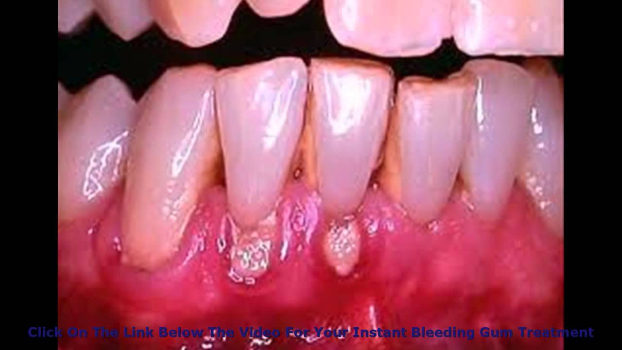 Get Rid Of Bleeding Gums In In One Week Fully Tested Bleeding Gums