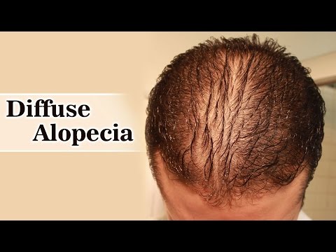Diffuse Alopecia Diagnosis And Treatment Youtube