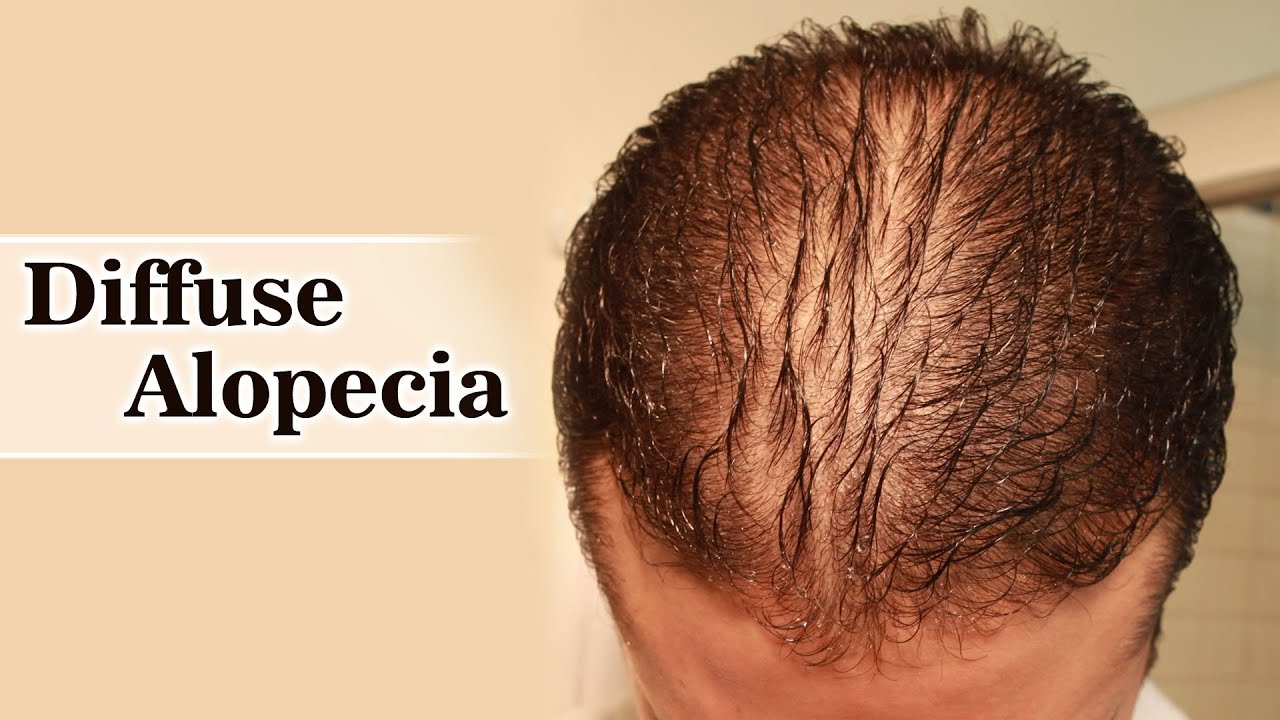 Diffuse Alopecia Diagnosis and treatment YouTube