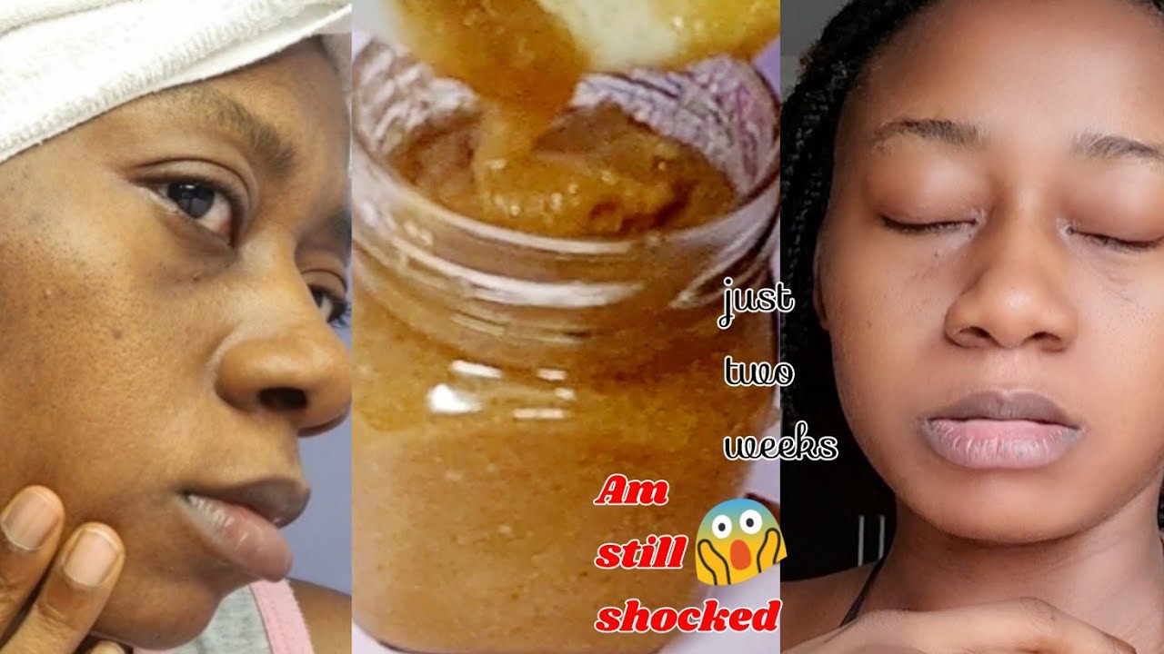 DIY SUGER SCRUB |I Faded my acne-prone scars and got clear skin doing ...