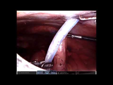 feeding jejunostomy in MIE