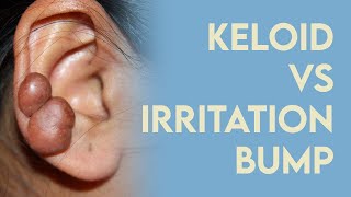 Keloid or Irritation Bump? How to fix 