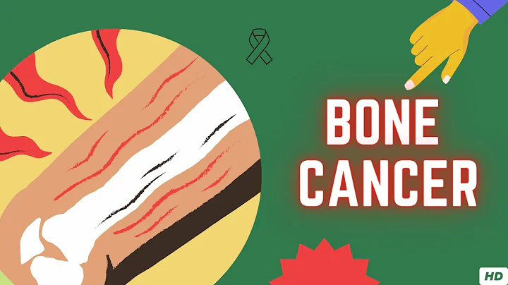 Bone Cancer, Causes, Signs and Symptoms, Diagnosis and Treatment. - DayDayNews