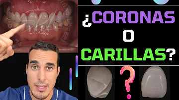 ¿Qué grosor tienen las carillas dentales?