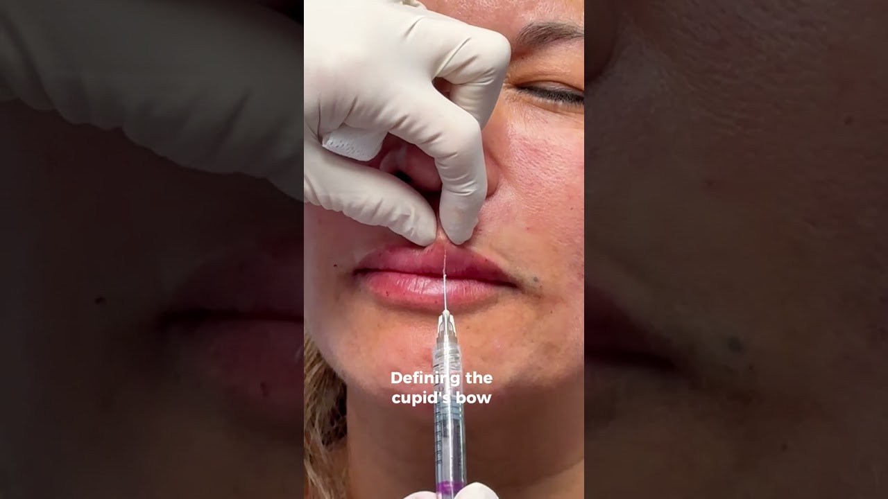Banner for 💘 Most people don't realize how much the cupid's bow shapes the entire look of your lips. #Filler