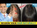 How To Stop Hair fall and Regrow Your Hair Naturally - Dr. Vivek Joshi