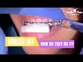 Braces off - What happens when you get your braces off - Tooth Time Family Dentistry New Braunfels