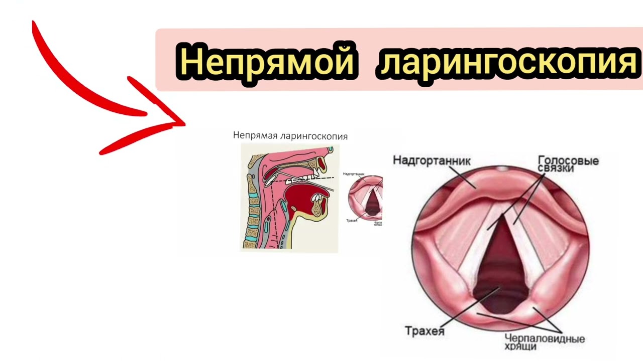 техника не прямая ларингоскопия