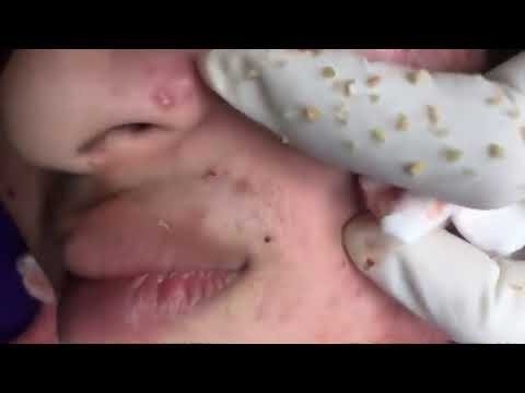 PIMPLE POPPING ON BACK,cystic acne,pimple popping big,dr pimple popper 