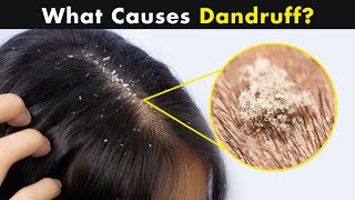 What is Dandruff? | Causes And Treatment (Urdu/Hindi) screenshot 1