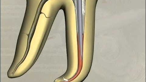 Vertical Condensation technique
