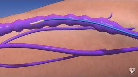 Guiding Light: een geanimeerde reis door endoveneuze thermische ablatie