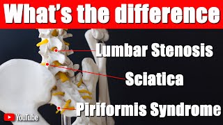 Are you suffering from Sciatica, Piriformis Syndrome or Lumbar Stenosis?  How to tell the difference