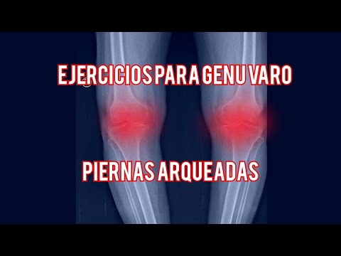 Video: ¿Tener las piernas arqueadas puede causar problemas?