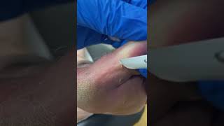 Dive Into This Aussie Podiatrist's Art Of Big Toe Callus Removal! #Footcaredownunder #Podiatrymagic